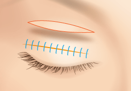 Full-incision double eyelid surgery