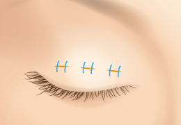 三點微切口法-雙眼皮手術