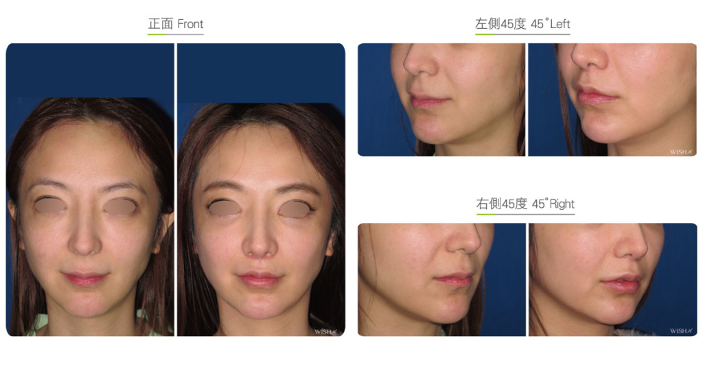 Philtrum Reduction Facial Surgery Wish Aesthetic Surgery Clinic