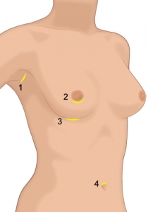 Breasts Surgery