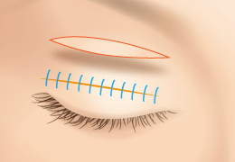 full incisional double eyelid surgery