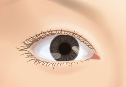 雙眼皮手術-閉合式雙眼皮