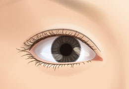 雙眼皮手術-開放式雙眼皮