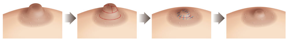 乳頭縮小與縮短手術示意圖