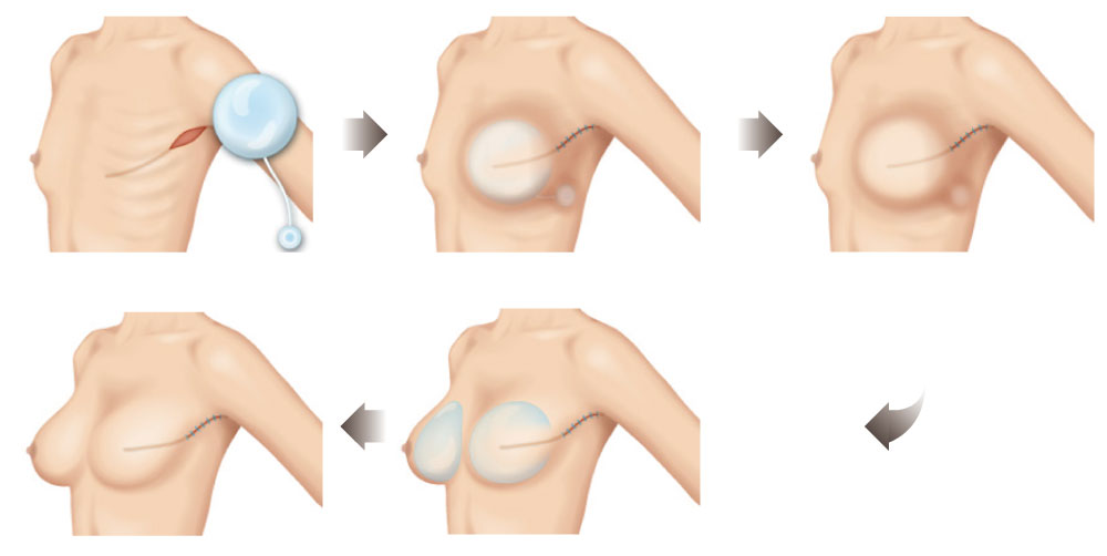 乳房重建-兩階段重建示意圖