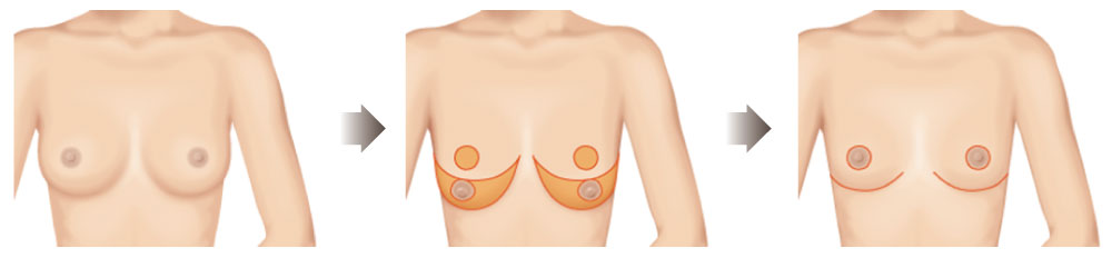 胸下緣切口縮乳法示意圖