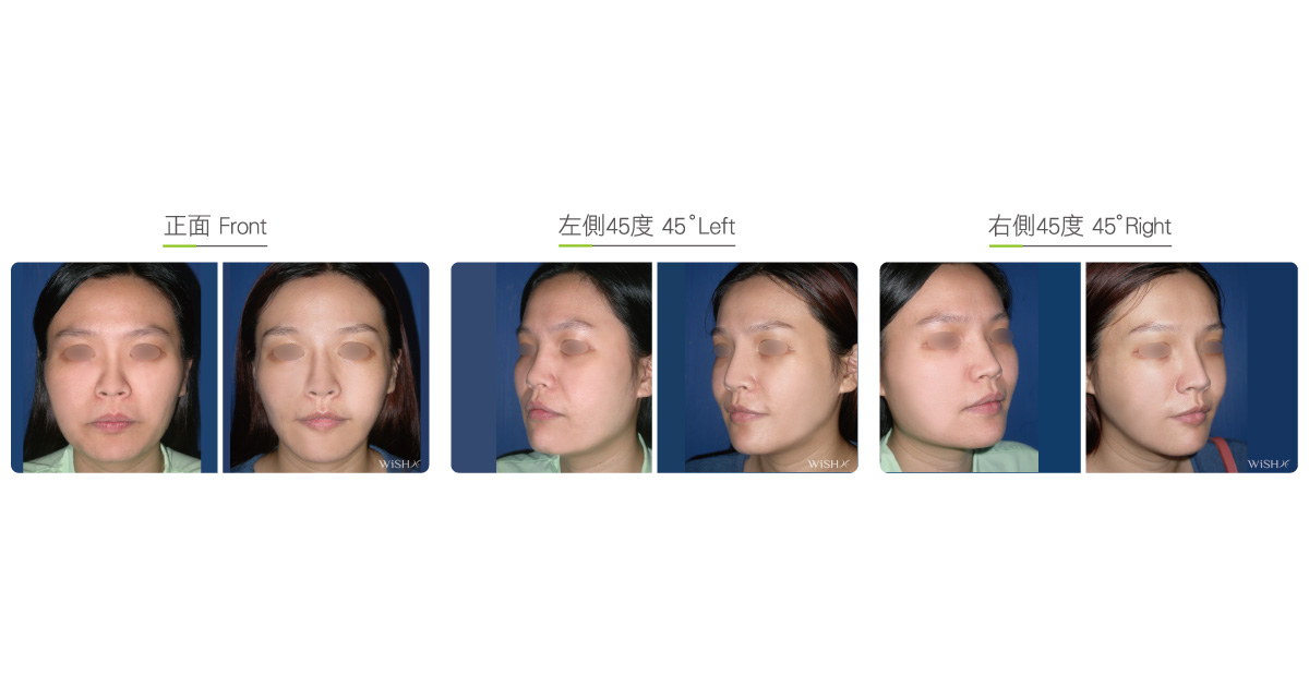 Bone-cheekbone+shaving-f-before-after-06 – 知美整形外科診所