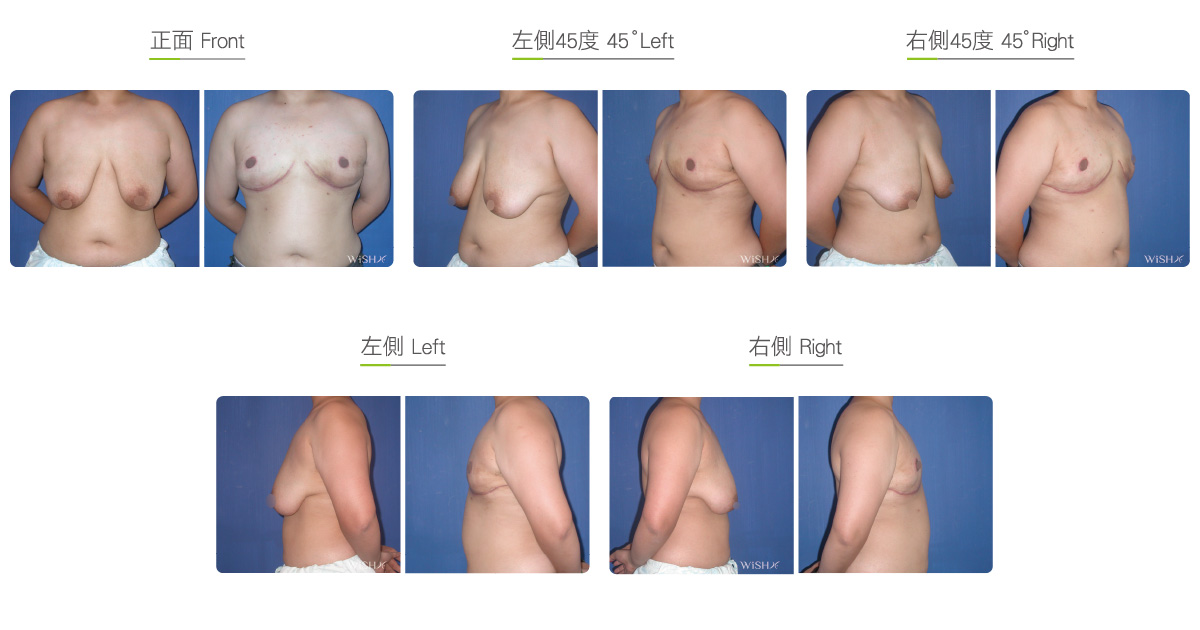 Female Breast Reduction - Before&After