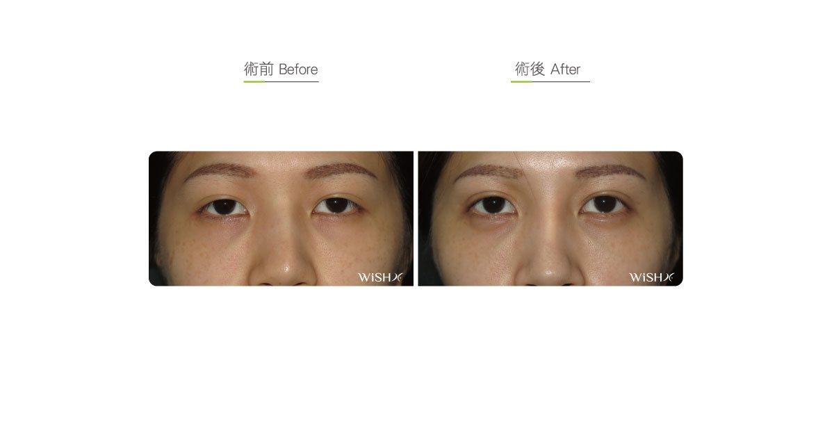 full incisional double eyelid surgery