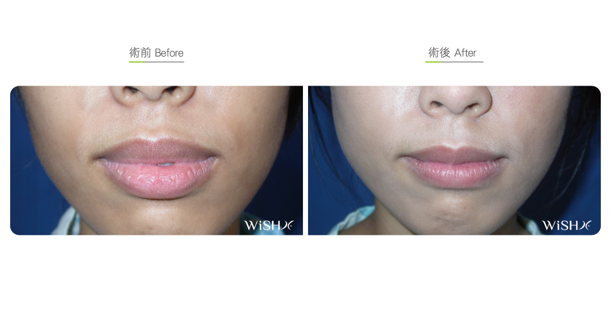 Lip Reduction Sexy Lip Surgery Lip Plasty Wishclinic