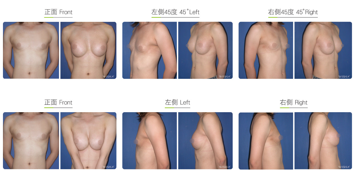 Male Breast Augmentation Wish Aesthetic Surgery Clinic