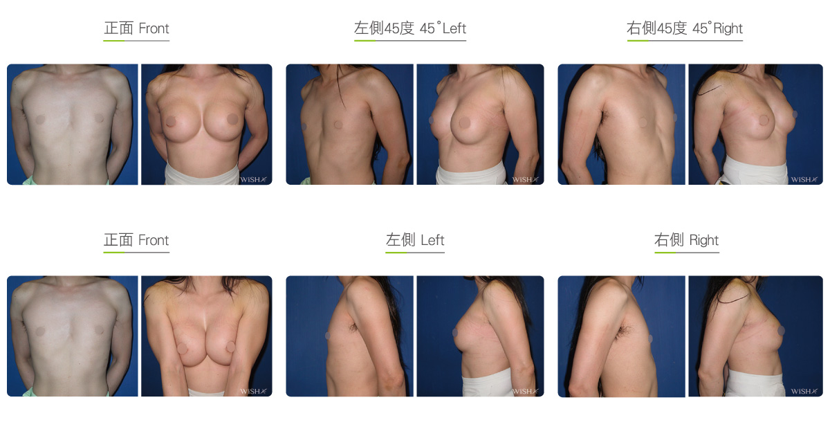 Male Breast Augmentation Wish Aesthetic Surgery Clinic