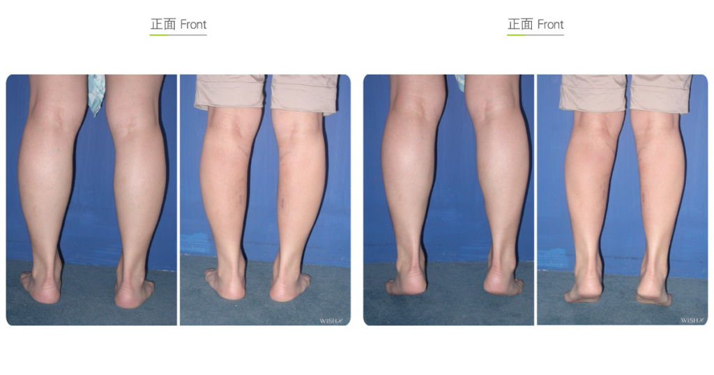 Calf Muscle Resection Wish Aesthetic Surgery Clinic
