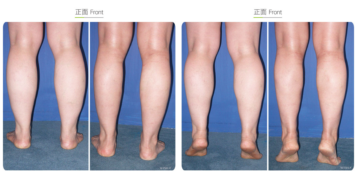 Calf Liposuction Before After Wish Aesthetic Surgery Clinic