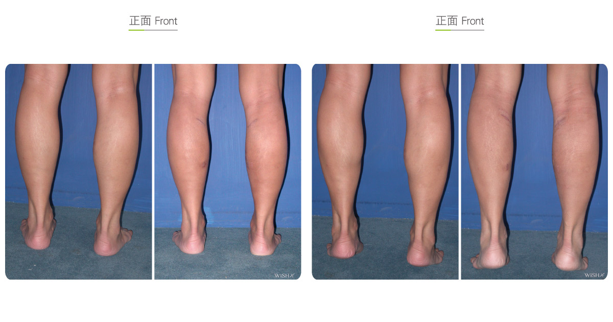 Calf Muscle Resection | Wish Aesthetic Surgery Clinic