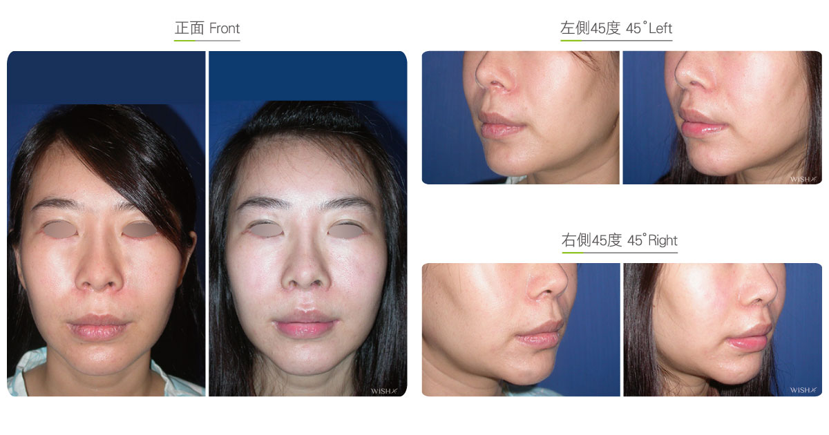 Philtrum Reduction Facial Surgery Wish Aesthetic Surgery Clinic