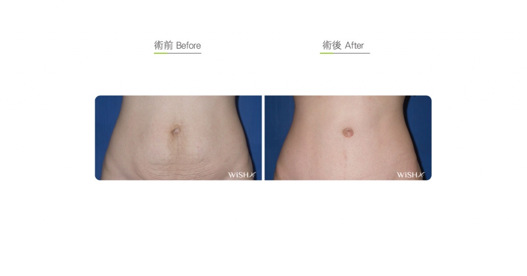 Umbilicoplasty-Belly-before-after-01 – 知美整形外科診所