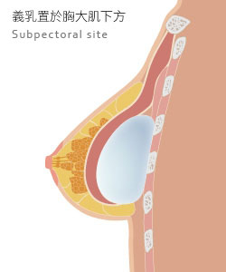 1. Aesthetic Breast Anatomy: Novel Insight for Improved Breast Implant  Design