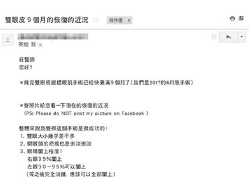 雙眼皮術後感言