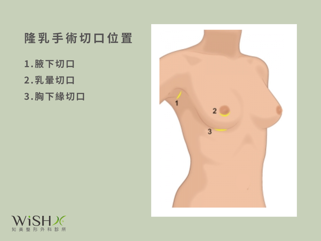 隆乳手術切口