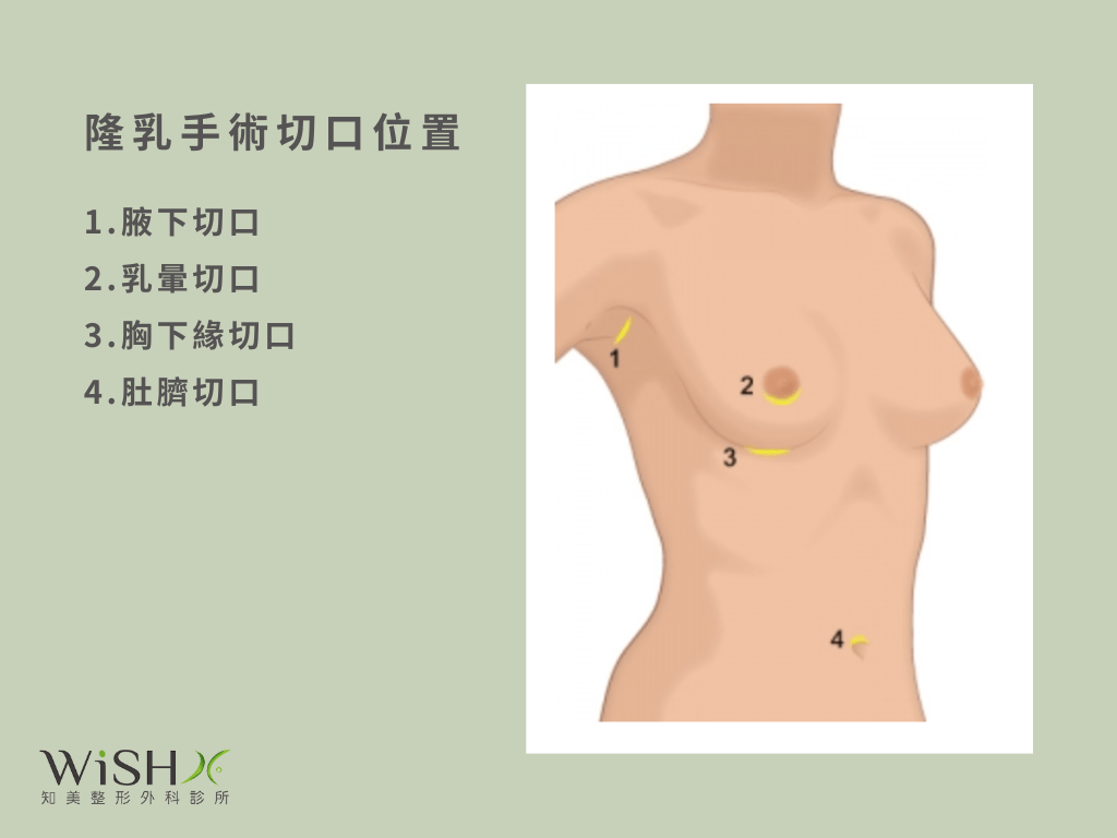 肚臍隆乳費用